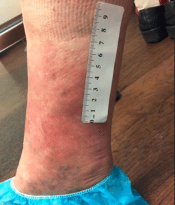After Image: Venous Ulcers