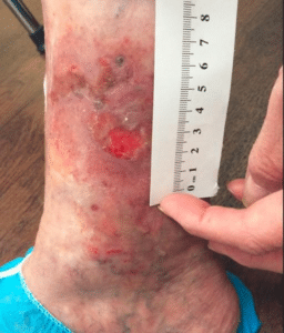 Before Image: Venous Ulcers