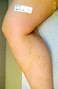 After Image: Spider Vein