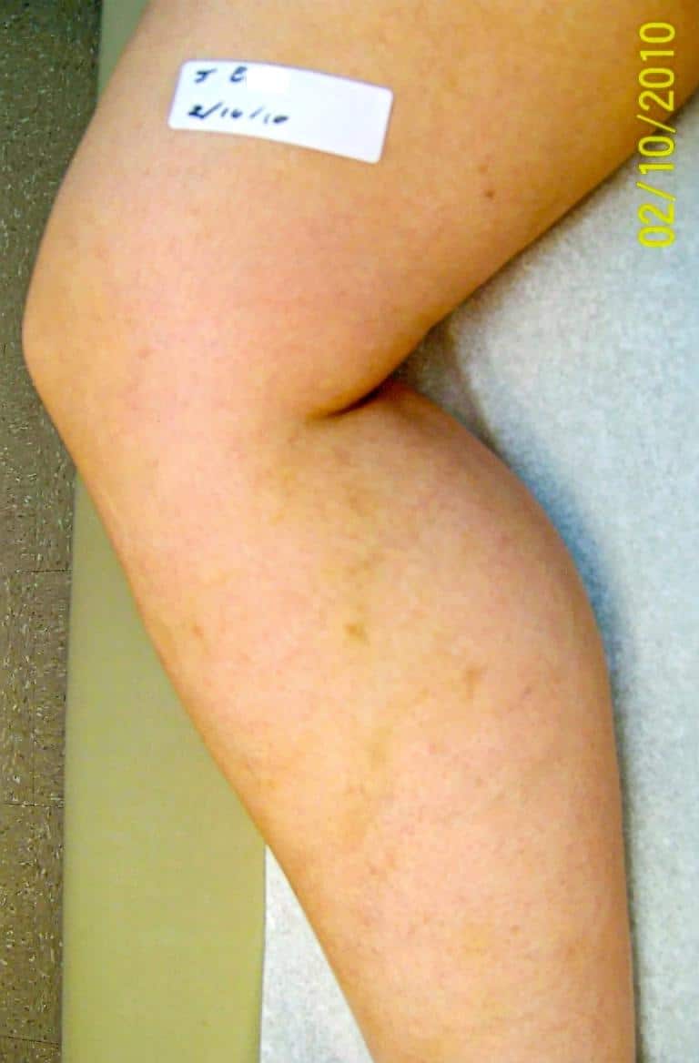 After Image: Spider Vein - front