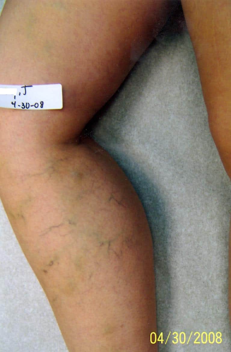 Before Image: Spider Vein - front