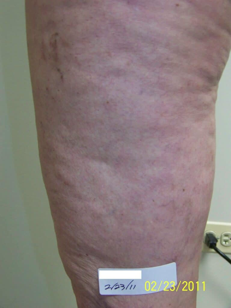 After Image: Spider Vein - front
