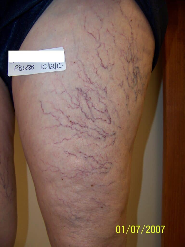 Before Image: Spider Vein - front