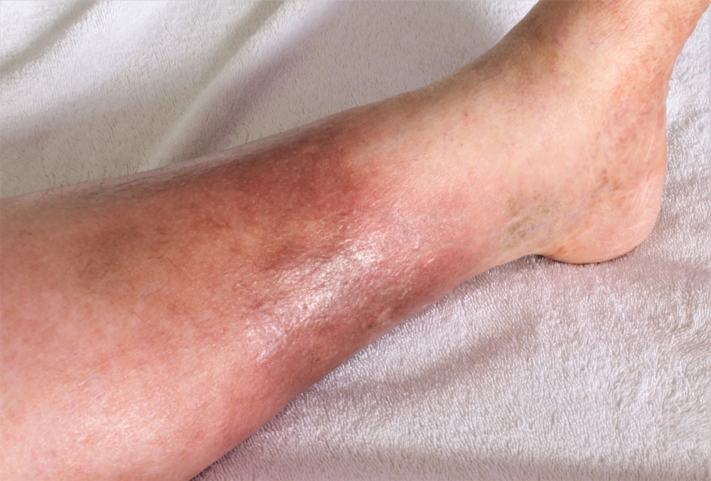 Close up of the red and enflamed leg of a patient who suffers from chronic venous insufficiency.