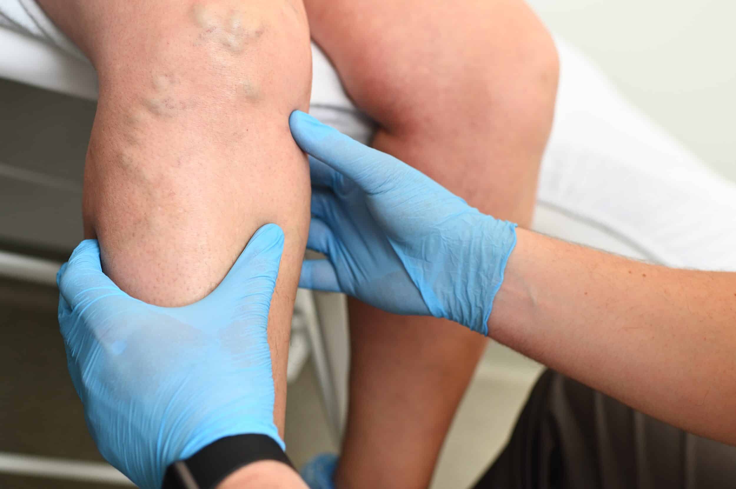 Doctor examines varicose veins in the leg of a person with restless leg syndrome