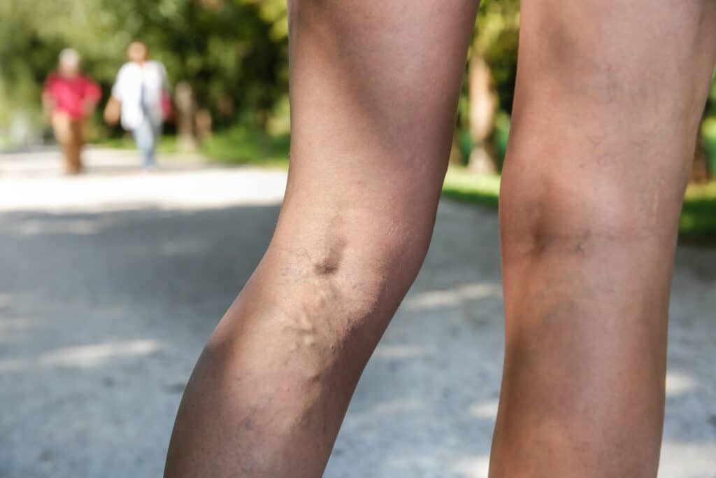 The backs of a woman's legs, showing bulging veins, before her EVLA treatment